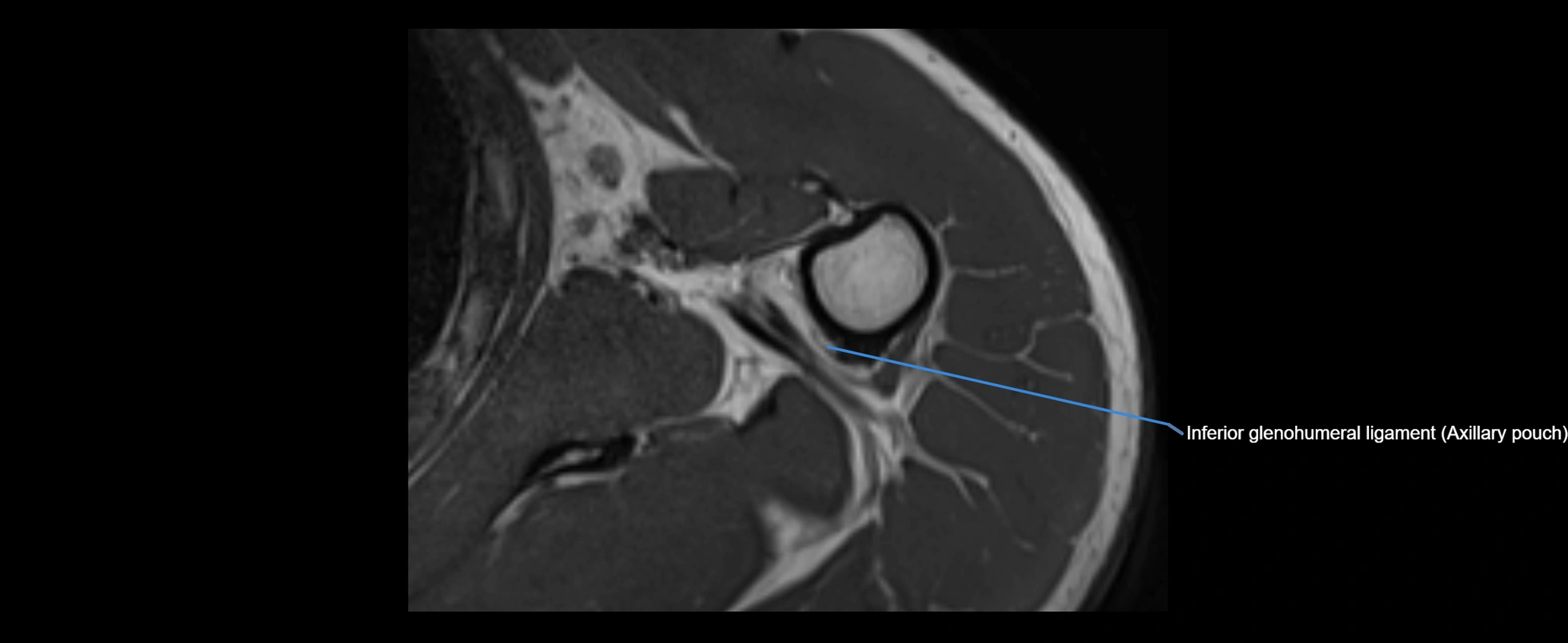 shoulder ligaments axial 3d 3t mri image-img-00005-00100.webp